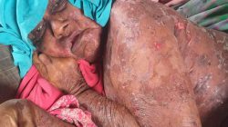 ‘Nenek Penuh’ sedang Sakit Kulitnya Melepuh Disekujur Tubuh (1)