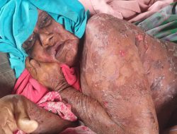 ‘Nenek Penuh’ sedang Sakit Kulitnya Melepuh Disekujur Tubuh (1)